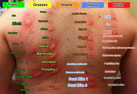 Skin allergy test 